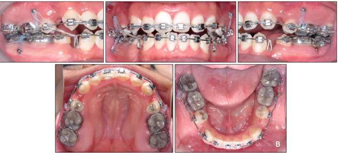 Fig 6.  A, Denture preparation: retraction of the maxillary and mandibular canines to level six anterior teeth