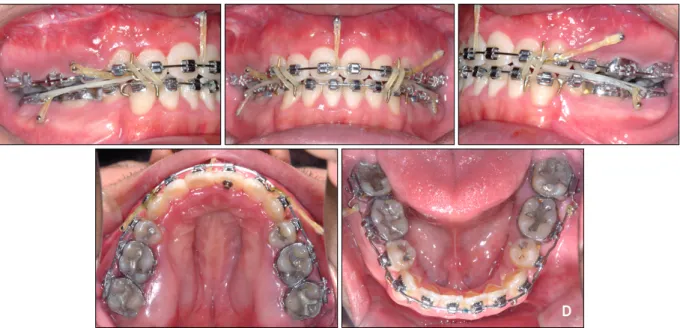 Fig 6. C, Denture correction: en masse retraction with closing loop archwire supported by maxillary posterior and an- an-terior microimplants