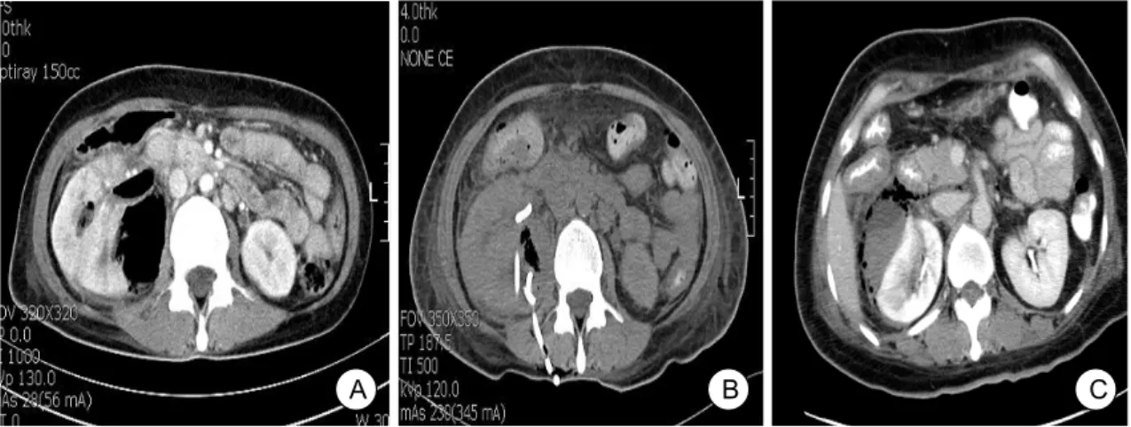Fig.  2.  (A)  Type  I  emphysematous  pyelonephritis.  Computed  tomography  (CT)  scan  of  the  abdomen  showed  abnormal  gas  without  fluid  collection  in  the  right  kidney