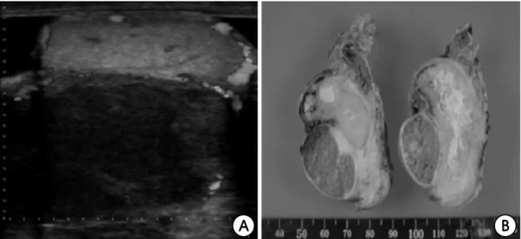 Fig.  2.  The  intravenous  pyelography  reveals  obstructed  dilated  left  distal  ureter  before  anti-tuberculosis  medication  (A),  and  normal  left  diatal  ureter  after  anti-tuberculosis  medication  (B).