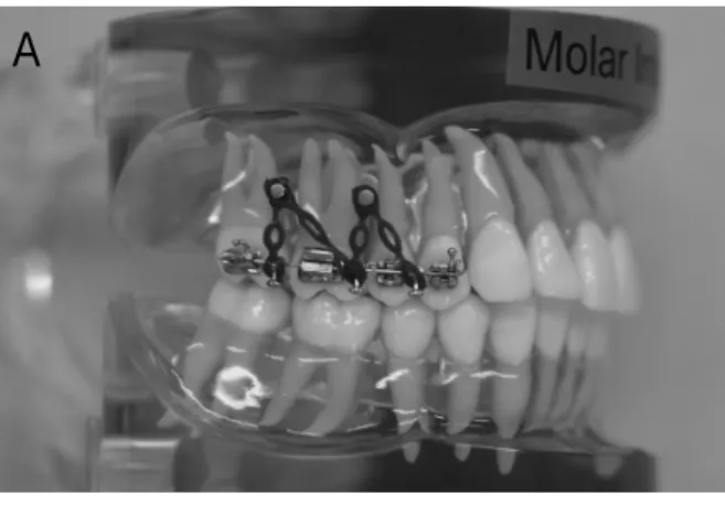 Fig 1. Appliance for intrusion of maxillary molars using miniscrew. A, Miniscrew insertion on buccal and palatal sides (buccal view); B, miniscrew insertion on buccal and palatal sides (palatal view); C, miniscrew insertion on the buccal side only, with a 