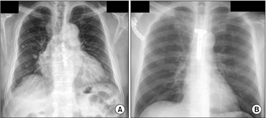 Fig. 1. Open reduction and internal  fixation of sternum with (A)  longi-tudinal plate with stainless steel  wiring and (B) T-shaped plate.