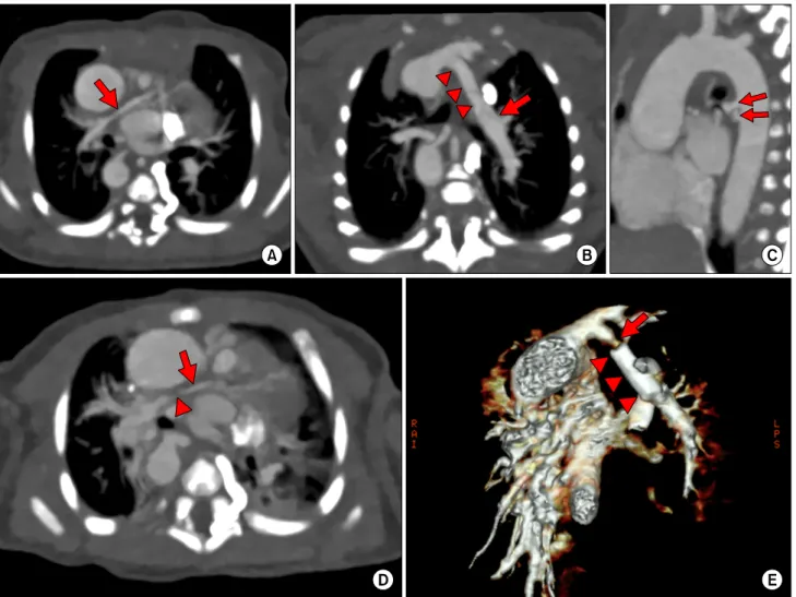 Fig. 1. Initial and post-stent follow up heart CT. Figures A–C are the initial heart CT image at one day old
