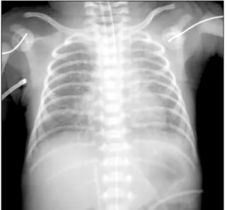 Fig. 1. Chest radiograph on admission showing diffuse pulmonary  infiltration of the bilateral lung fields.