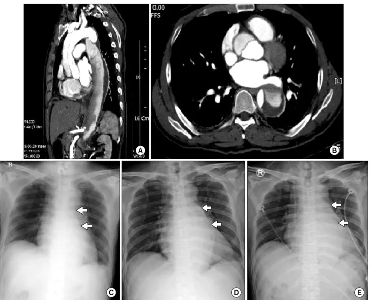Fig. 1. (A) Preoperative computed tomography revealed a Stanford type A aortic dissection (sagittal plane)