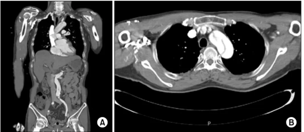Fig. 2. A Stanford type A aortic dis- dis-section documented on (A) a  coro-nal and (B) an axial chest  com-puted tomography scan.