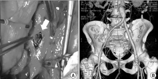 Fig. 4. Follow-up computed tomography 2 years after the operation.