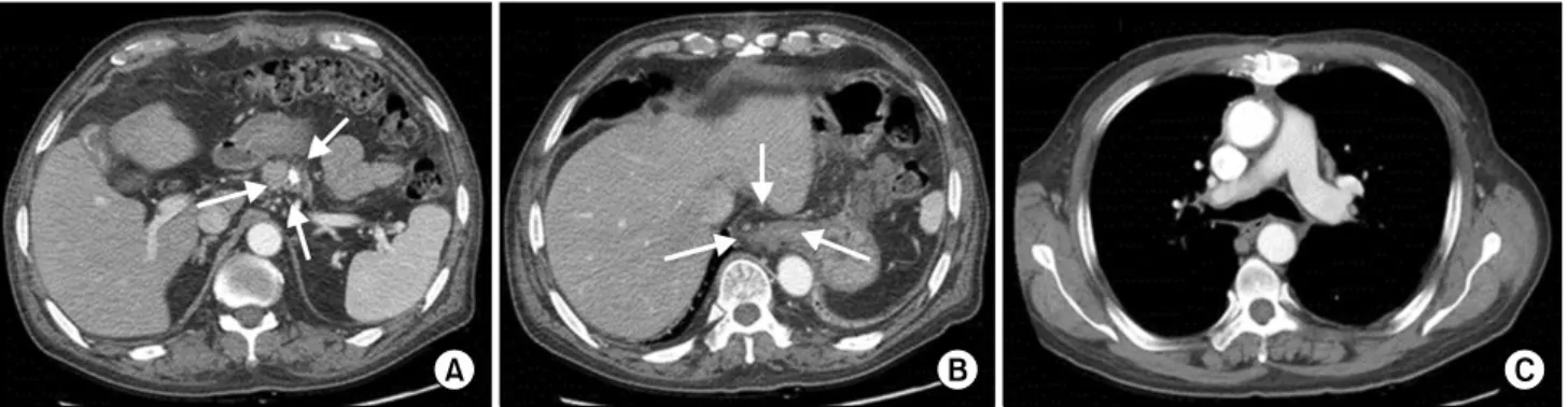 Fig. 3. Axial view of aortic contrast-enhanced computed tomography one year after the operation
