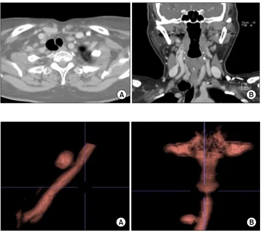 Fig. 1. (A, B) Initial preoperative  computed tomography scan  show-ing the tracheal diverticulum  posi-tioned on the right posterolateral  aspect of the trachea.