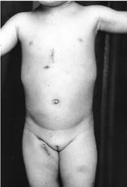 Fig. 1. P os tope ra tive photogra m s hows s urgica l wound a t the low che s t 로는 양측 및 우측 유방하절개, 우전측부개흉술, 우측흉골연 절개, 여러 형태의 부분흉골절개, 검상돌기하절개 등이 보고 되었다