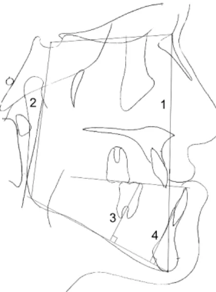 Fig  2. Angular measurement of lateral cephalometric  films. 1, SNA (SN plane to NA plane); 2, SNB (SN  plane to NB plane); 3, ANB (NA plane to NB plane); 
