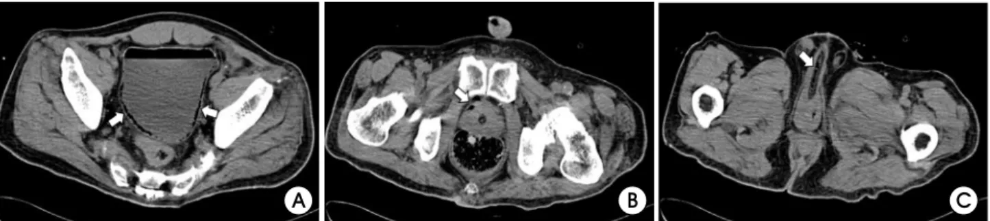 Fig.  1.  The  abdominal  computed  tomography  reveals  multiple  mottled  gas  bubbles  (arrows)  within  bladder  wall  (A),  prostate  (B)  and  urethra  (C).