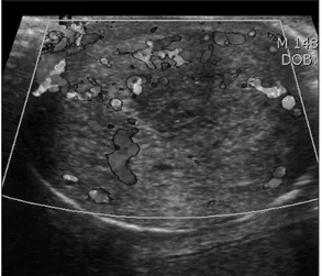 Fig.  2.  Color  doppler  US  shows  the  increased  vascularity  of  the  penile  soft  tissue.