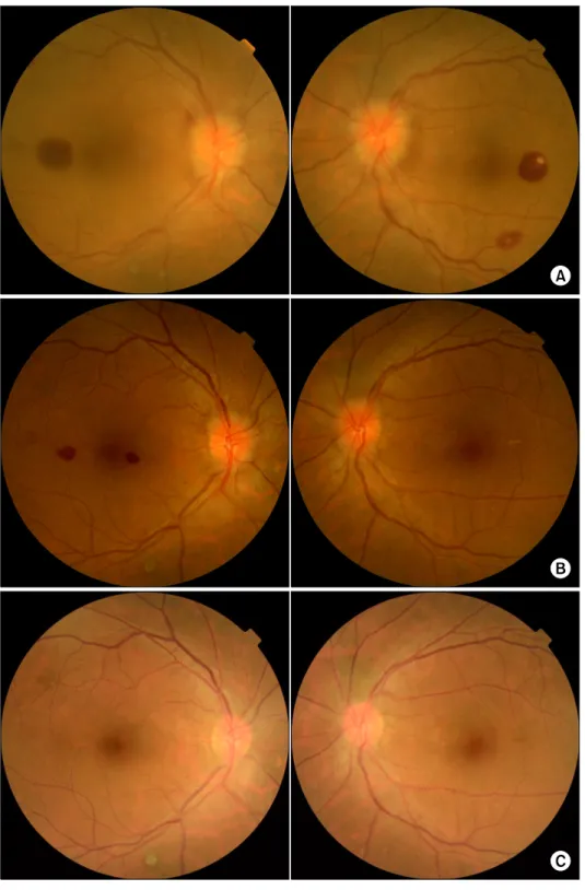 Fig. 1. Fundoscopic findings of Roth  spots. (A) Preoperative findings. (B)  2 weeks postoperatively