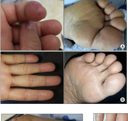 Fig. 3. Janeway lesions. (A) Preoperative findings. (B) 6 weeks  postoperatively.