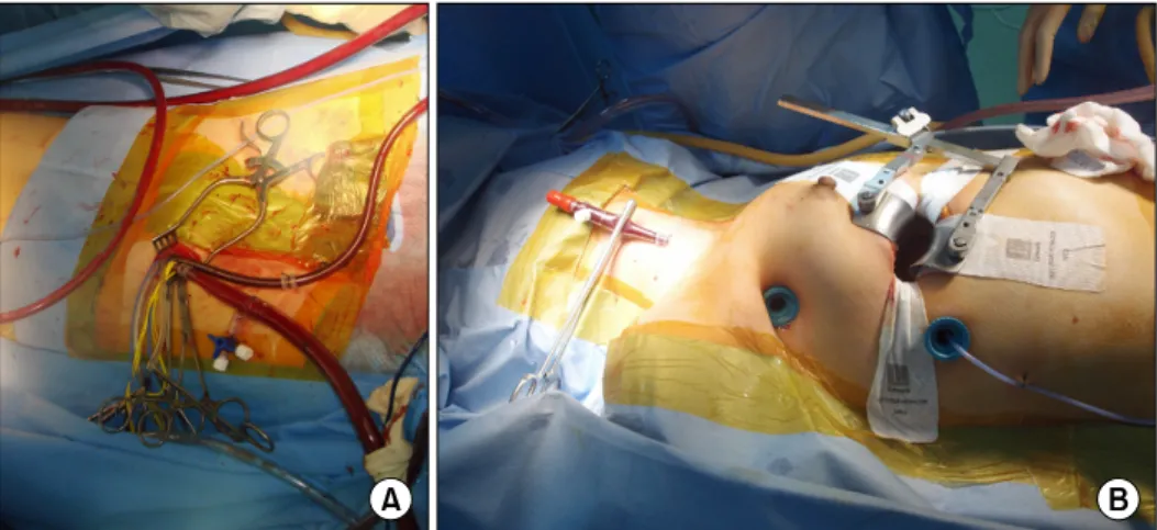 Fig. 1. (A) Femoral artery and vein  cannulations are performed. (B) Right internal jugular vein cannulation  and right anterolateral thoracotomy are performed.