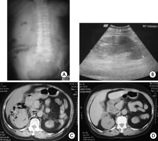 Fig.  1.  A.  KUB  shows  a  gas  shadow  in  right  renal  area.  B.  Ultrasonography  shows  a  linear  echogenic  air-line  in  right  renal  area