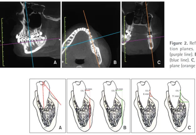 Figure 3. Analysis of the mandibular buccal shelf. A, Angulation: This is measured as the inner angle made by the axial  axis of the molar and a tangent to the outermost surface of the buccal shelf