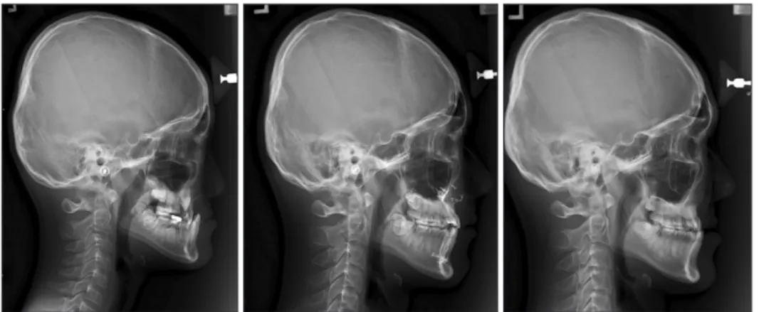 Figure 2. An example of in- in-stallation of two additional  miniplates on the mandibular  symphysis and use of Class III  elastics between the maxillary  and mandibular miniplates at  day time and facemask with  miniplate at night time
