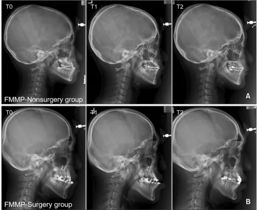 Figure 1. Serial lateral ceph- ceph-alograms taken before  face-mask with miniplate (FMMP)  therapy (T0), after FMMP  therapy (T1), and follow-up  (T2) in the FMMP-Nonsurgery  group (A) and FMMP-Surgery  group (B).