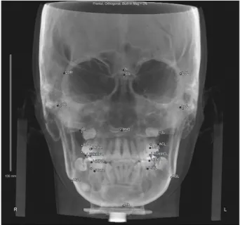 Figure 6. Many structures layered in vertical dimension. The condyle and dentoalveolar areas of the posteroanterior (PA)  cephalograms interfere with the artificial intelligence image recognition ability