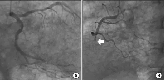 Fig. 1. Preoperative chest computed tomography. Subpleural and  peribronchovascular reticulation with macrocystic honeycombing is visible in both lungs.
