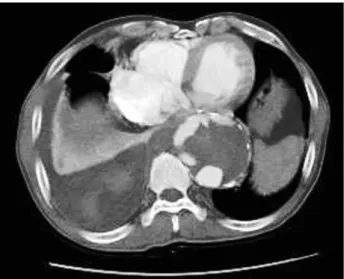 Fig. 3. The arrow indicates multiple endoleaks from the graft,  which were suspected to be due to a late Dacron graft rupture.