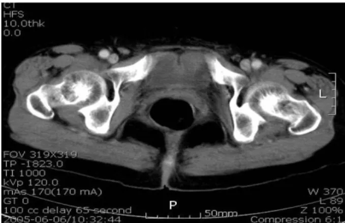 Fig.  3.  Abdominal  computerized  tomography  shows  the  track  around  the  bladder  anterior  wall,  not   com-munication  with  bladder.