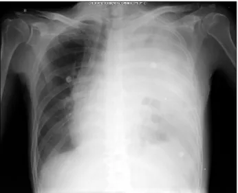 Fig. 2. (A) Ruptured esophagus. Levin tube placed inside the ruptured esophagus (white arrow)