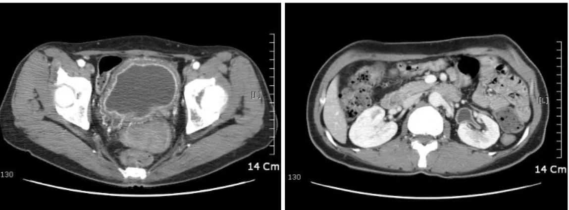 Fig.  1.  Computed  tomography  shows  thickening  of  enhanced  bladder  and  left  ureteral  wall,  and  left  hydrone-  phroureterosis.