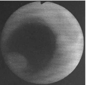 Fig . 4. S imple che s t x- ra y on the third da ys a fte r pla ce me nt of the s te nt in the tra che a s hows no dis pla ce me nt of the s te nt in pos ition a nd fully e xpa nde d.
