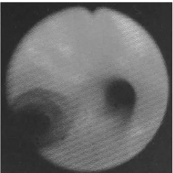 Fig . 6. Bronchos copic finding. No s te nos is of the tra che a wa s found 8 months a fte r re mova l of the s te nt.
