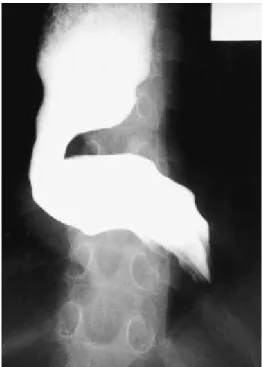 Fig. 2. (a ) CT s ca n s hows a ma s s of re la tive ly low s oft- tis s ue a tte nua tion ne a r the junction a nd compre s s e d e s opha ge a l lume n