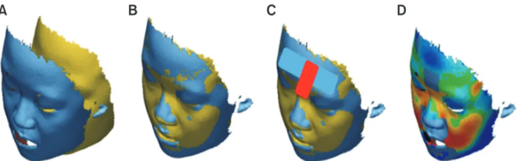 Figure 5. Superimposition and measurements for evaluation of nasal soft tissue changes using stereophotogrammetry  after microimplant-assisted rapid palatal expansion (MARPE)