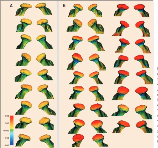 Figure 6. The superior view  of all condylar  superimposi-tions in the control (A) and  experimental (B) groups (CG  and EG, respectively)