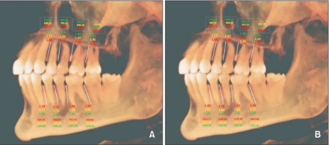 Figure 6. Intergroup comparisons of hyperdivergent, hypodivergent, and normodivergent subjects for cortical bone  thickness at the respective interdental locations