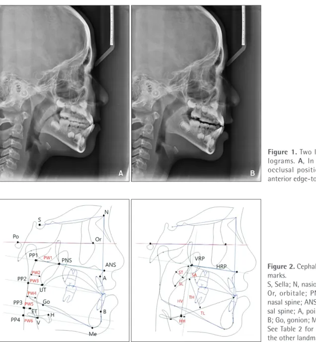 Figure 1. Two lateral cepha- cepha-lograms.  A, In the habitual  occlusal position. B, In the  anterior edge-to-edge bite.