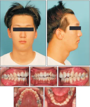 Figure 9. First phase posttreatment 3-dimensional dental  models.