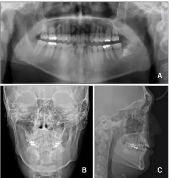 Figure 12. Second phase  treatment progress.