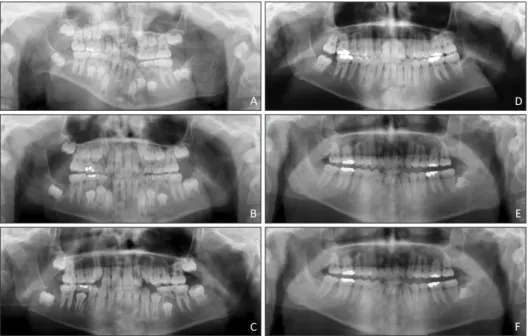 Figure 15. Panoramic ra- ra-diographs from first phase  to second phase treatment. 
