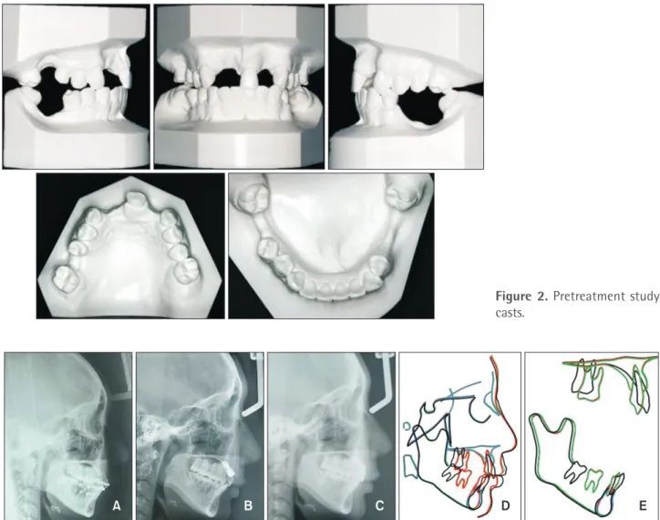 Figure 3. Lateral cephalogram, tracing, and superimpositions. A, Immediately after attaching the orthodontic appliances; 
