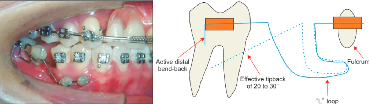 Figure 5. A photo showing progress of 6 months into treatment and a diagram of the applied mechanics of mandibular  second molar uprighting and protraction.