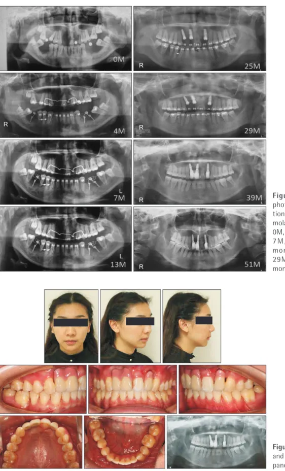 Figure 7. Serial panoramic  photograph showing  protrac-tion of the mandibular second  molars