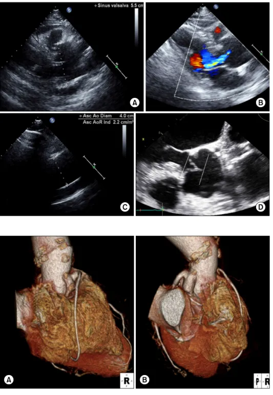 Fig. 2. (A, B) Postoperative computed tomographic images (3-dimensional  reconstruction) show reconstructed  neo-sinuses, interleaflet triangles,  and patent coronary artery button  anastomoses.