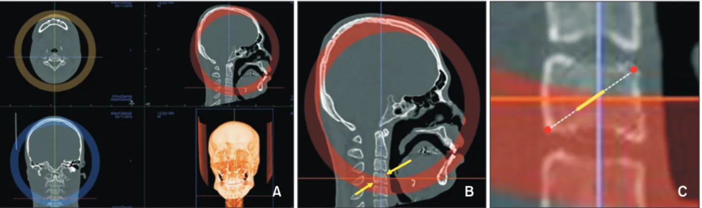 Figure 7. Bone density measurements for the fourth cervical vertebrae (C4). A, Orientation of computed tomography  images for C4
