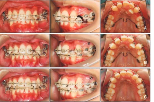 Figure 4. Pretreatment cone-beam computed tomography images. A, Transverse image at the apex level of the maxillary  incisor roots