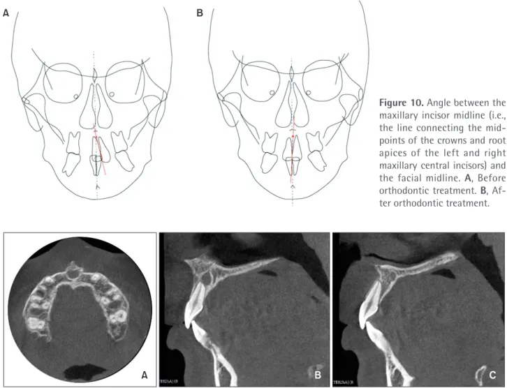 Figure 11. Post-treatment cone-beam computed tomography images. A, Transverse image at the apical level of the max- max-illary incisor roots