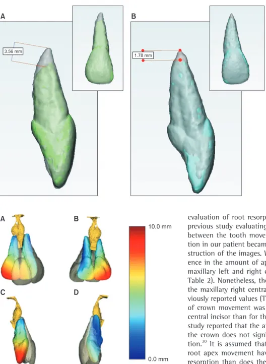 Figure 12. Superimposed  three-dimensional models of  pre- and post-treatment  max-illary central incisors
