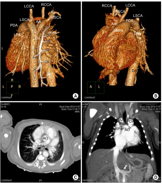 Fig. 1. (A–D) Computed tomography  angiography showing right AA with  retroesophageal LSCA and  anom-alous origin of pulmonary artery  from aorta