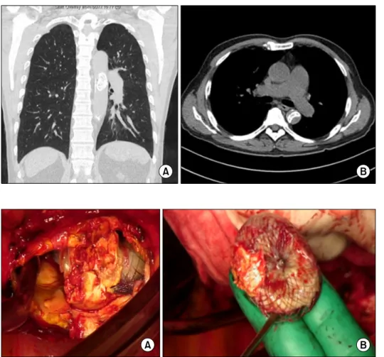Fig. 1. (A, B) Chest computed to- to-mography scan showing the  mi-grated Amplatzer occluder device.